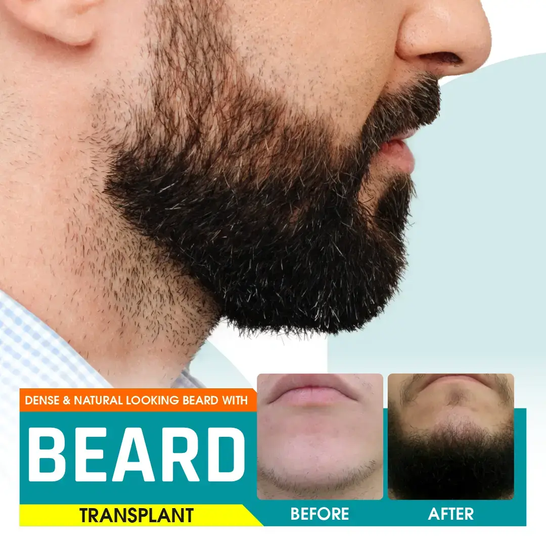 Beard & Moustache transplant